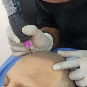 Scalp micropigmentation procedure in progress.