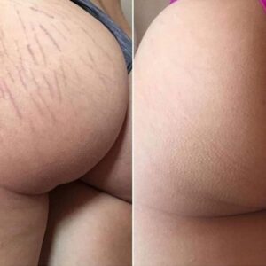 Buttocks Stretch Marks Service