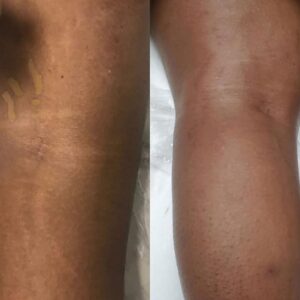 Before and after treatment for varicose veins.