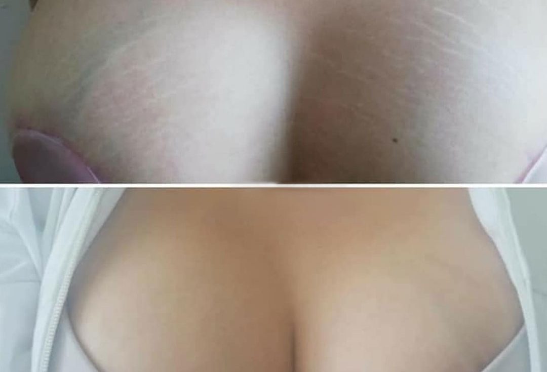 breaststretchmarks